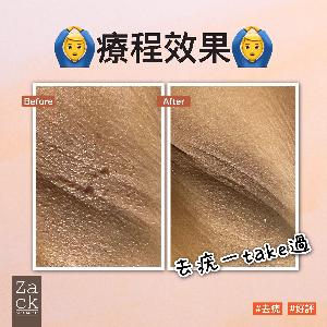 韓國碳化無疼脫尤/油脂粒 (全面任脫 - 體積2mm直徑或以內)/每粒