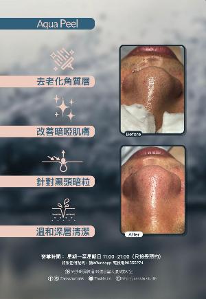 Aqua Peel深层淨化疗程-体验价
